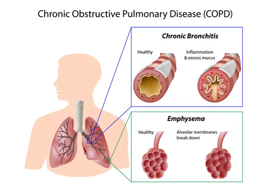 Chronic obstructive pulmonary disease (COPD) Treatment London