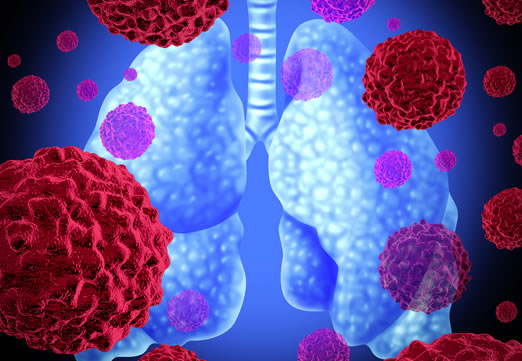 Lung Cancer Treatment London